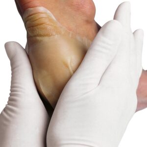 Hydrocoll (Similar to Granuflex) Hydrocolloid Dressing 15cm x 15cm (Singles)